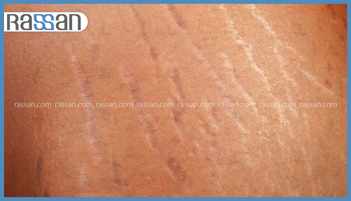 بهترین کرم برای جلوگیری از ترک شکم در بارداری 2 نمای نزدیک از خطوط و استریا یا ترک شکم بارداری