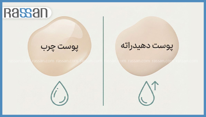 پوست چرب بهتره یا خشک؟ مقایسه کامل + تست تشخیص نوع پوست 2 تفاوت بین پوست چرب و پوست دهیدراته و کمآب