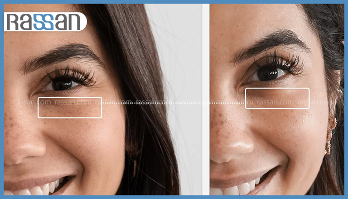 کرم دور چشم چیست؟ فواید، ترکیبات، روش استفاده و راهنمای انتخاب بهترین کرم 2 مقایسه و بررسی تیرگی و پف زیر چشم قبل و بعد از درمان