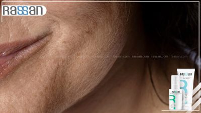 ۷ راهکار عملی برای درمان خشکی پوست در فصل زمستان