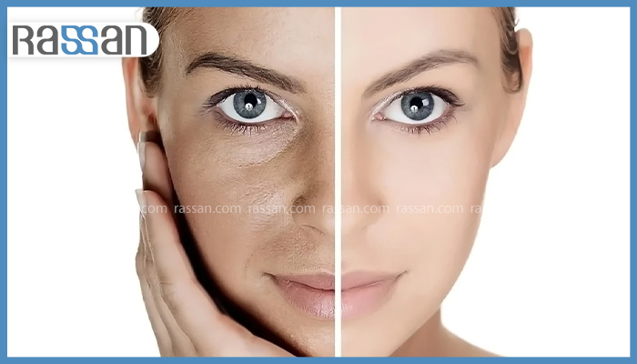 Syn Ake یا بوتاکس؟ کدام یک برای جوانسازی پوست بهتر است؟ 3 مقایسه دو نیمه صورت یک زن؛ سمت چپ با منافذ باز، تیرگی و بافت ناهموار پوست و سمت راست کاملاً صاف، روشن و بینقص