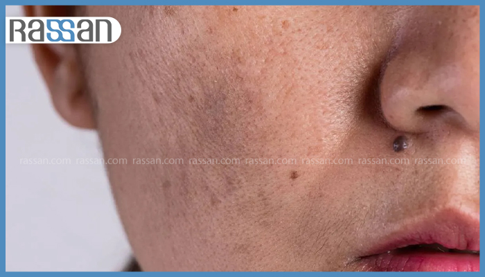 بهترین کرم برای لک قهوه ای صورت و بدن 2 روشنسازی پوست