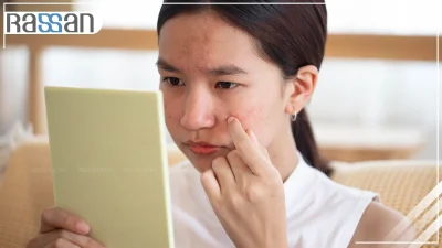 از بین بردن جوش صورت در خونه؛ راهکارهای ساده، سریع و طبیعی