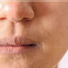 درمان خشکی پوست؛ راهکارهای تضمینی برای رهایی از پوسته‌های صورت در پاییز و زمستان