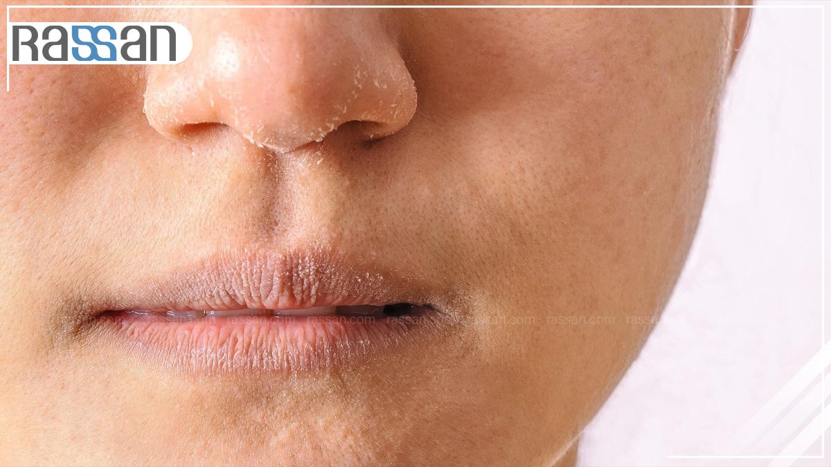 درمان خشکی پوست صورت