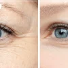 بوتاکس طبیعی صورت | بهترین روش‌های جوانسازی پوست و رفع چین ‌و چروک