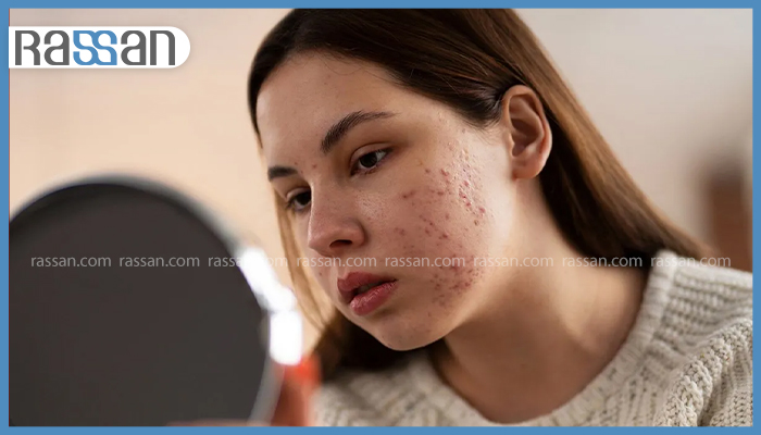 آیا ژل ویتامین C برای جای جوش مؤثره؟ 4 دختر جوان ناراحت در حال نگاه کردن به آینه و بررسی جوشهای فعال و لکهای قرمز روی گونه