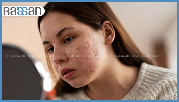 نمای نزدیک از جوش‌های شدید، آکنه و لک‌های پوستی روی صورت یک دختر جوان در حال نگاه کردن به آینه، برند راسن